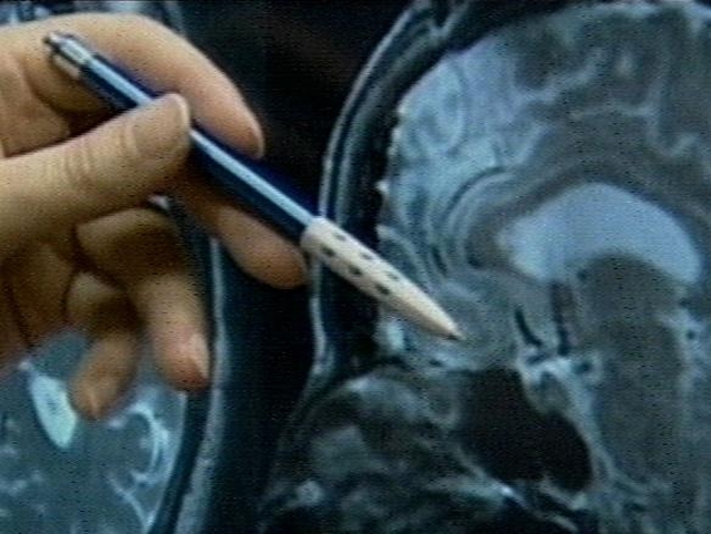Dementia - 44,000 people with the condition in Ireland Dementia - 44,000 people with the condition in Ireland