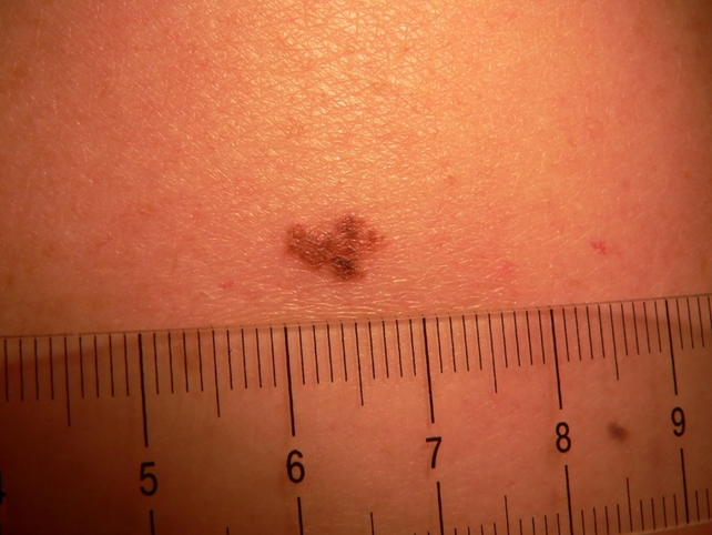 Melanoma - Concern over increase in cases Melanoma - Concern over increase in cases