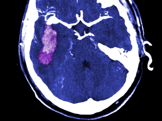 Stroke - Report on cardiovascular services Stroke - Report on cardiovascular services