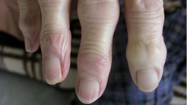 Arthritis Ireland has expressed concerns over rates of discretionary medical card reviews among those suffering with the condition Arthritis Ireland has expressed concerns over rates of discretionary medical card reviews among those suffering with the condition