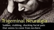Trigeminal Neuralgia