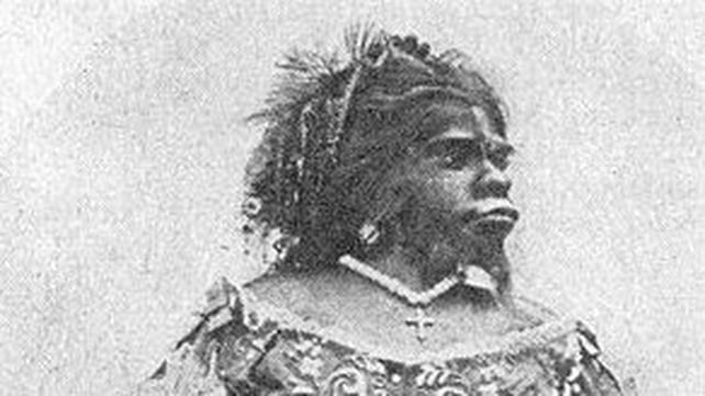 Julia Pastrana suffered from hypertrichosis and gingival hyperplasia Julia Pastrana suffered from hypertrichosis and gingival hyperplasia