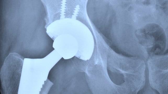 Around 6,500 metal-on-metal hips were fitted to Irish patients Around 6,500 metal-on-metal hips were fitted to Irish patients