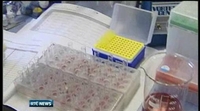 One News: HSE to contact patients affected by CJD scare One News: HSE to contact patients affected by CJD scare