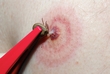 Lyme's Disease