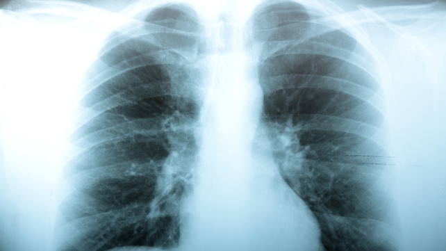 Emphysema is caused by inflammation of the alveoli, the sponge-like tissues that take oxygen into the lungs Emphysema is caused by inflammation of the alveoli, the sponge-like tissues that take oxygen into the lungs