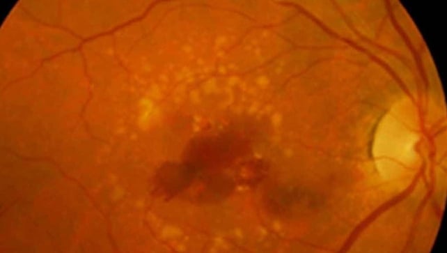 Wet AMD sees the blood vessels in the eye grow abnormally and leak, causing almost immediate blindness Wet AMD sees the blood vessels in the eye grow abnormally and leak, causing almost immediate blindness