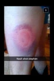 Hurling Injury
