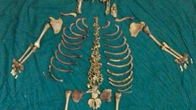 The 60-year-old woman became pregnant at 24 but had a miscarriage (Pic: NKP Salve Institute of Medical Sciences) The 60-year-old woman became pregnant at 24 but had a miscarriage (Pic: NKP Salve Institute of Medical Sciences)