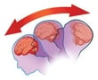 Concussion
