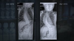 13-year-old Kerry boy waiting for scoliosis surgery