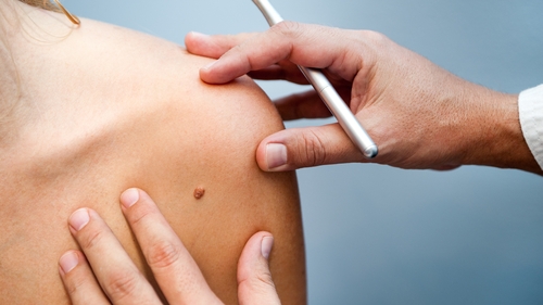 Skin cancer in Ireland rose by 70% in 10 years Skin cancer in Ireland rose by 70% in 10 years