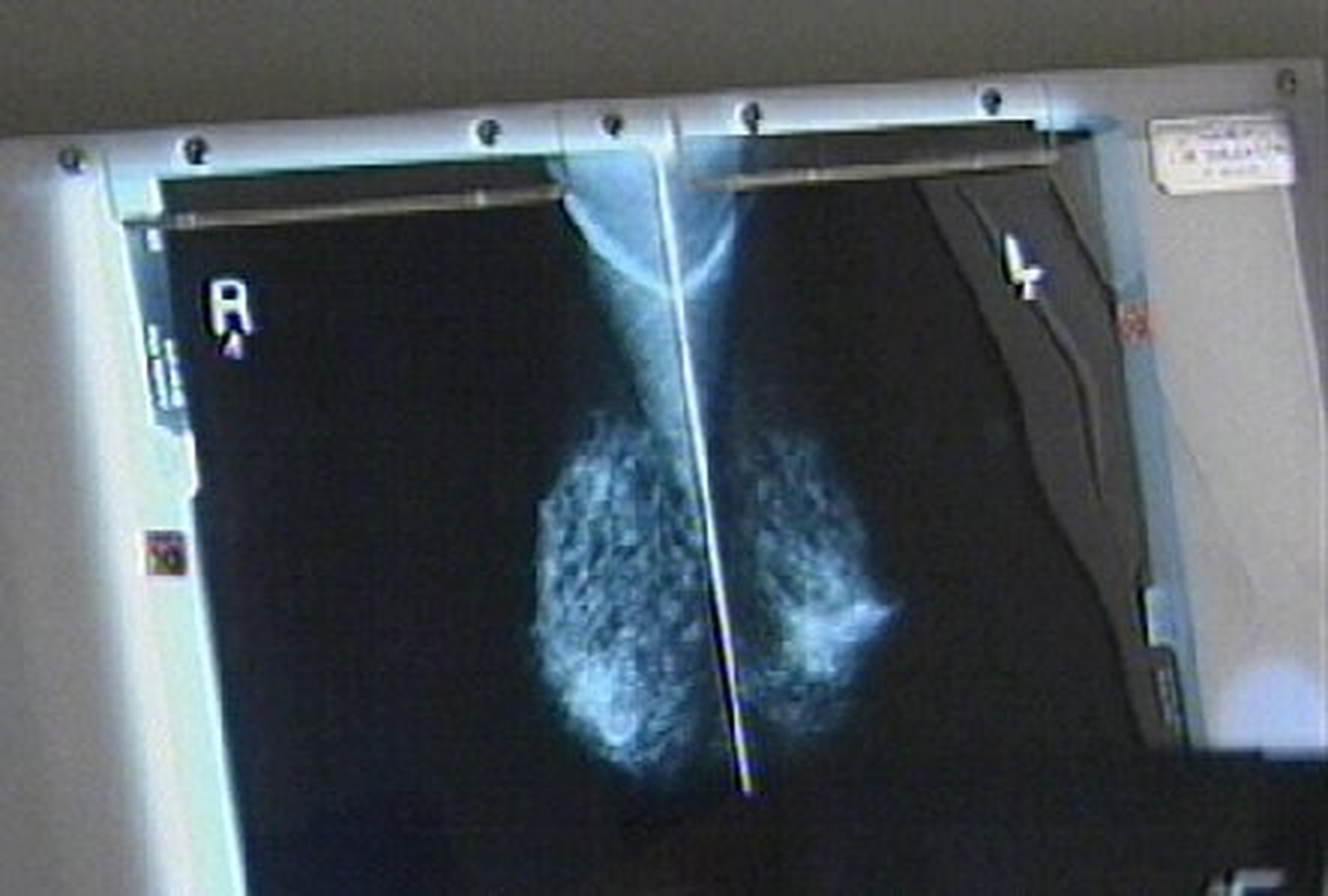 Breast Screening Programme Criticised   00002736 1600 