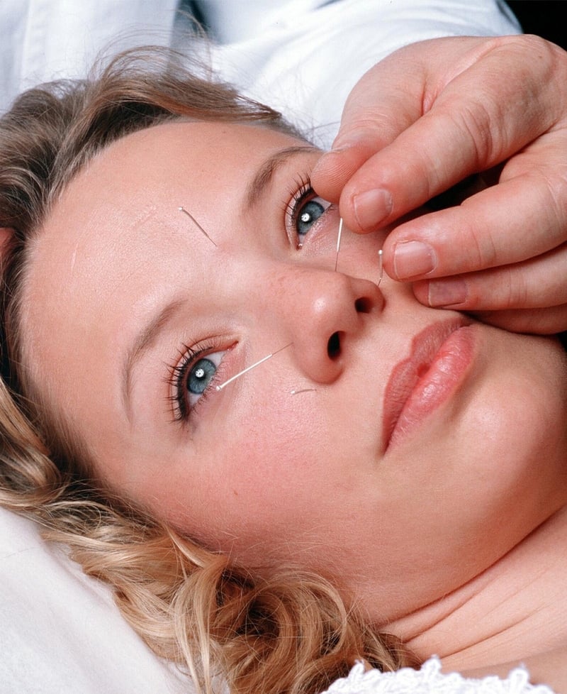 Cosmetic Acupuncture The Facelift without surgery