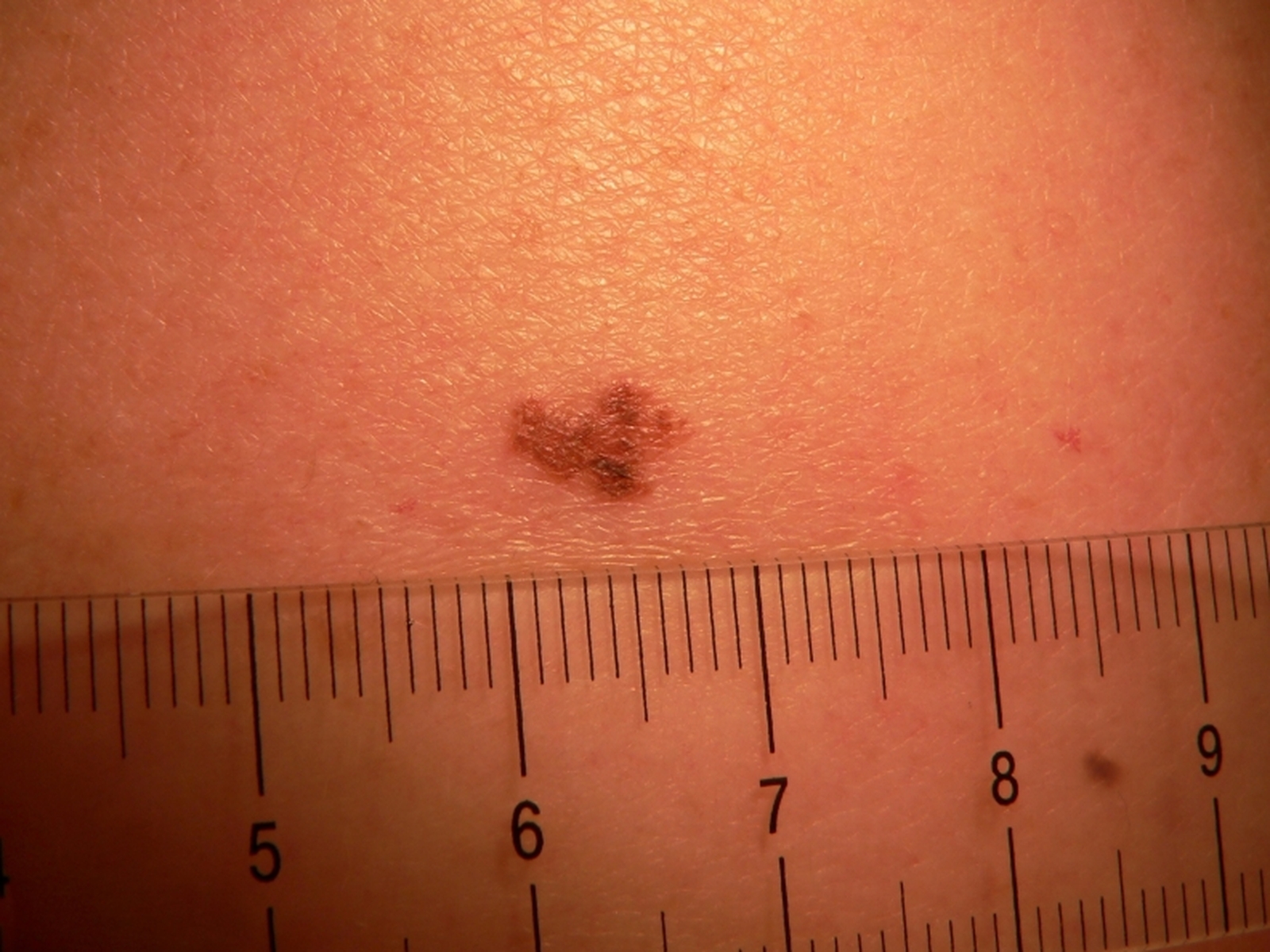 36-increase-in-skin-cancer-cases