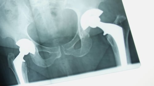 Hip implant - Worldwide recall issued last August