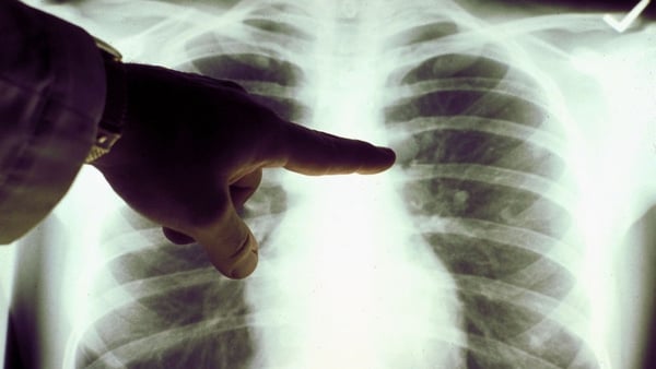 Most lung cancers are diagnosed at late stage when people present to emergency departments