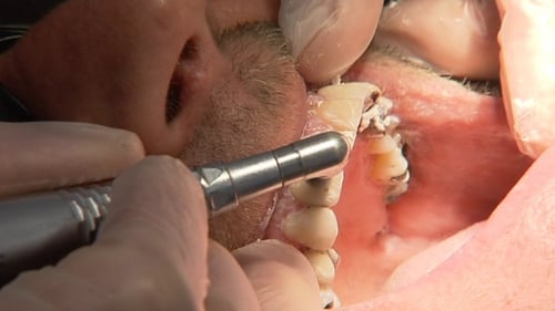 Dentists - Rise in oral cancers noted