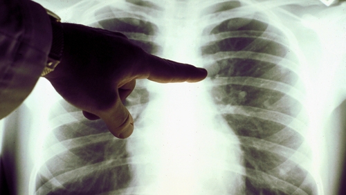 Lung cancer is biggest cause of cancer death