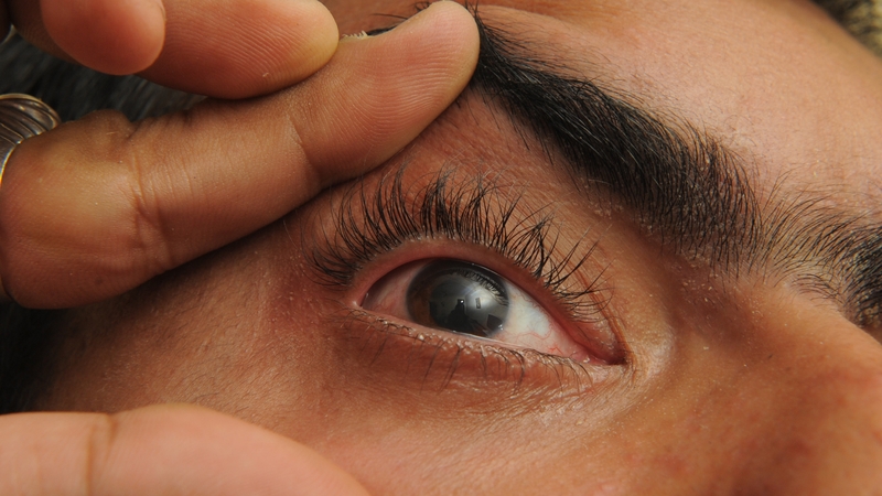 concussion flickery eyesight concussion flickery eyesight