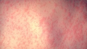 Measles is highly infectious and can have serious complications