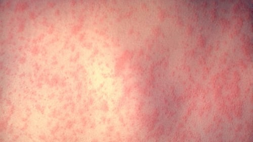 The HSE said it is a community outbreak of measles affecting adults and children
