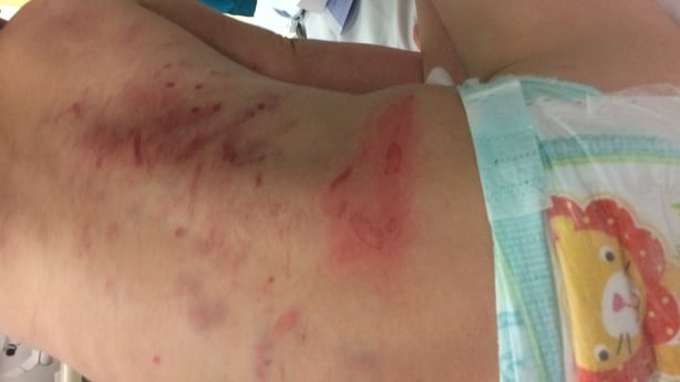 Injuries sustained by Reilly