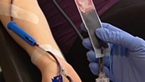 Excess glucose damages a vital enzyme involved with inflammation response to the early stage of the disease