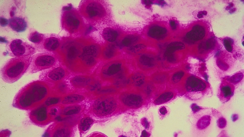 New exhibition examines the evolution of cancer