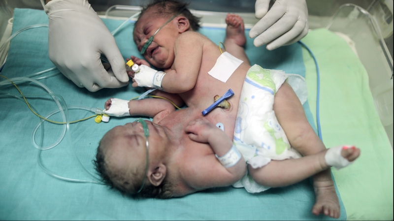 Baby girls Farah and Haneen were joined at the abdomen