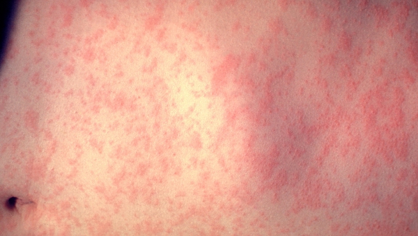 Measles infection typically causes a rash, fever, conjunctivitis, cough or runny nose