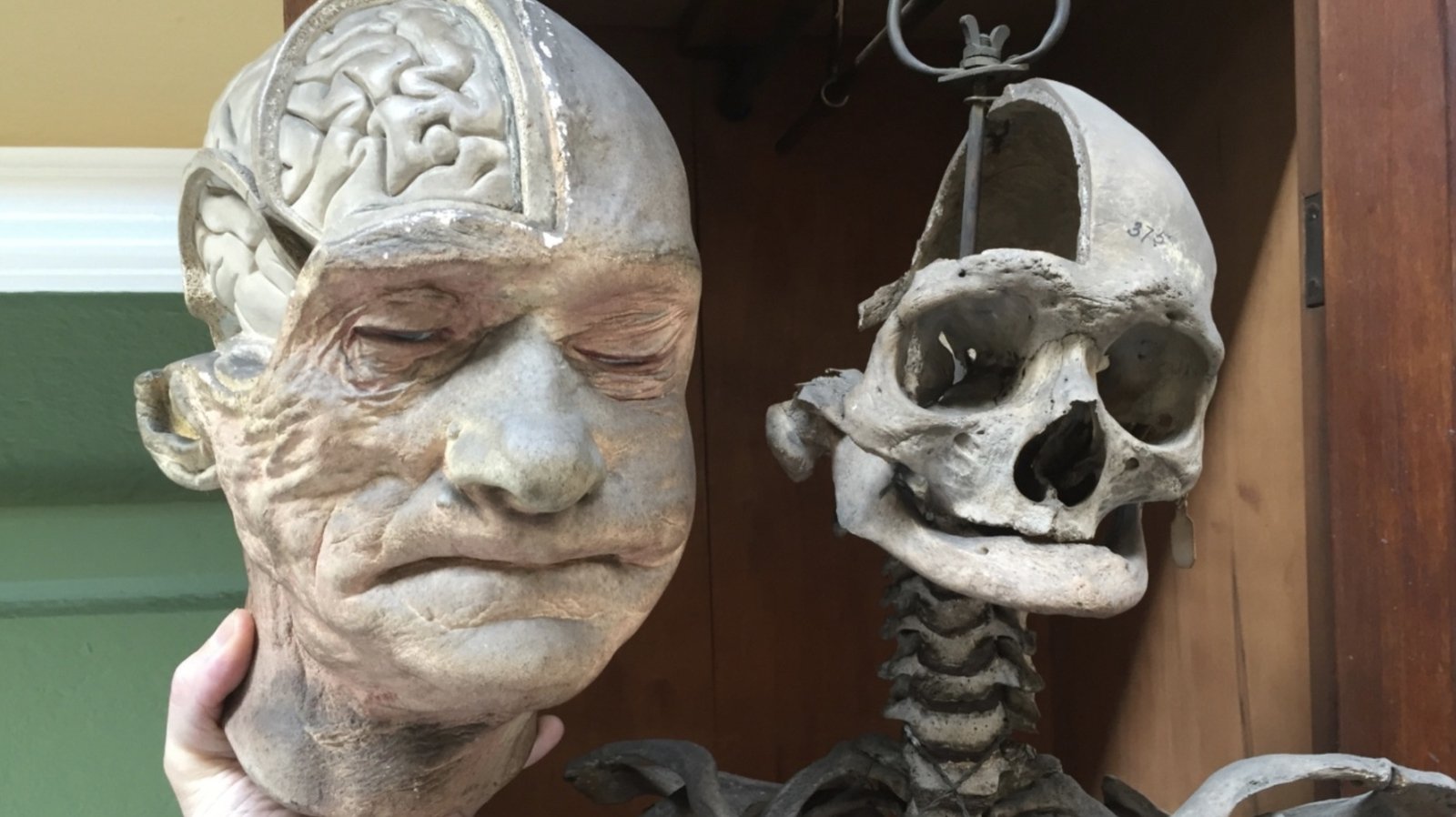 Image - Plaster cast and skeleton of centenarian James Conway. Photo by Siobhan Ward.