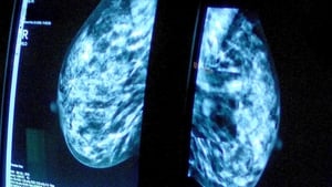 'Significant milestone': HSE approves breast cancer drug