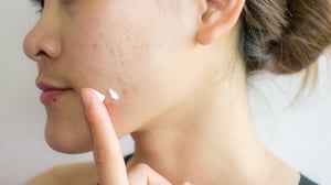 Laser treatment for skin