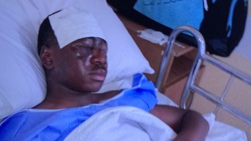 Tega Agberhiere has been transferred to Cork University Hospital for treatment at the specialised burns unit there