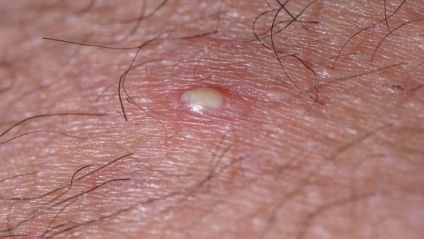 Ingrown hair can look like a pimple (iStock/PA)