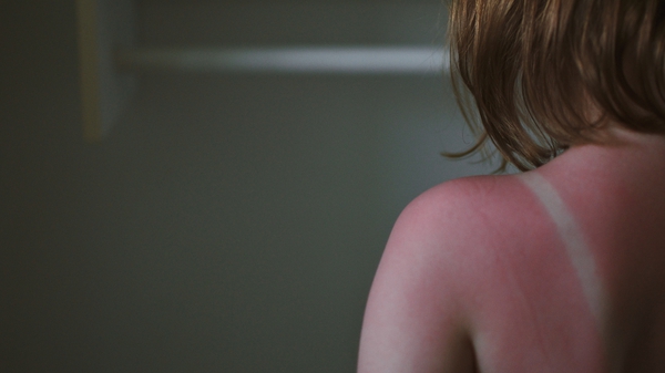 Childhood sunburn increases the risk of developing skin cancers later in life