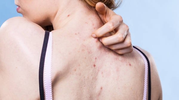 Annoying at best and painful at worst, back acne can be a real issue for some.