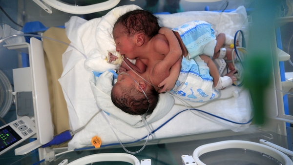Doctors said the twins have their own heart but they are not sure if any other organs are connected