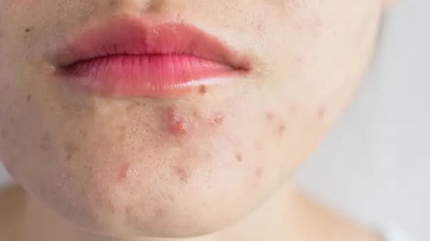 Apple cider vinegar is sometimes hailed for its skin benefits