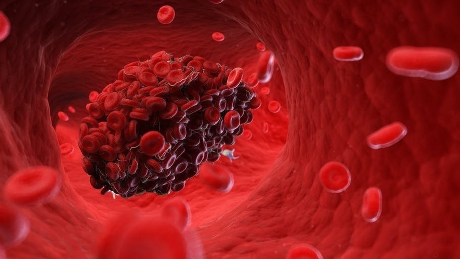 5 reasons why blood clots may occur in the body