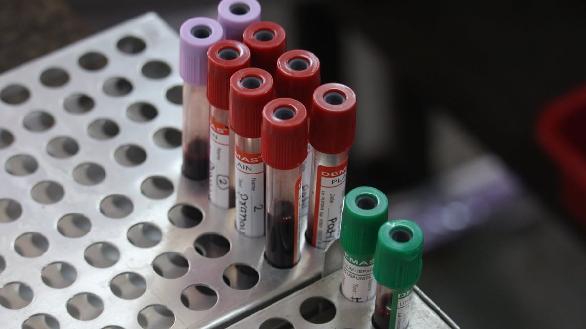 Calls for more screening to test for rare diseases Calls for more screening to test for rare diseases