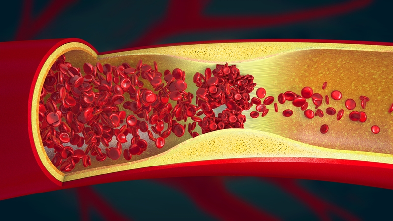 Irish Researchers Investigate Covid-19 Related Clotting