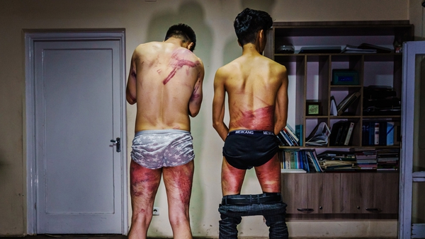 Journalists Nemat Naqdi, 28, (left) and Taqi Daryabi, 22, show their wounds sustained by Taliban fighters