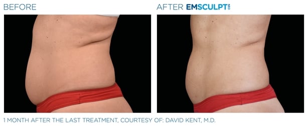 Emsculpt Neo  Before & After, Honest Opinion! 