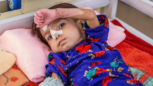 18-month old Amina is recovering from severe acute malnutrition in Herat Regional Hospital
