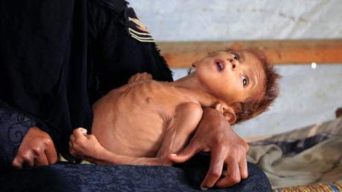 Meshaal Mohammad, suffering from acute malnutrition, is held by his mother at a camp for the displaced in Hajjah province (File pic)