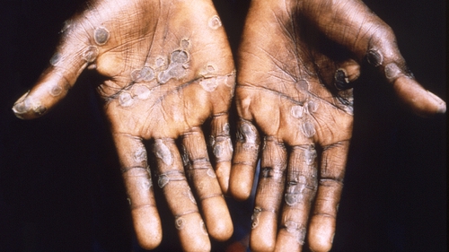 Close-up of a patient's hands showing lesions from the monkeypox virus in the Democratic Republic of Congo