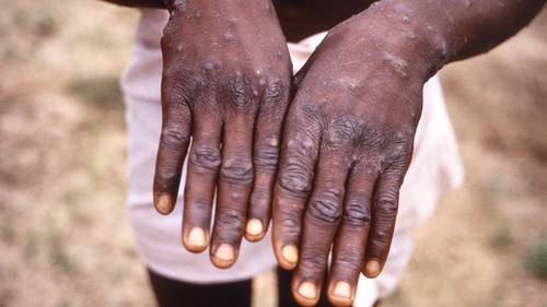 Monkeypox does not usually spread easily between people (File image)