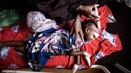 A severely malnourished two-year-old girl is fed via a tube in Banadir Maternity and Children Hospital in Mogadishu